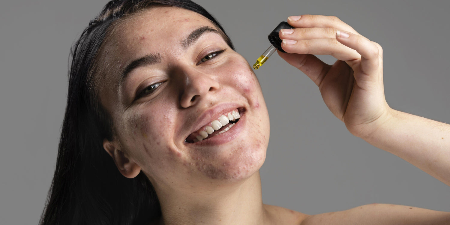 A Gentle Guide to Calming Hormonal Acne on Sensitive Skin