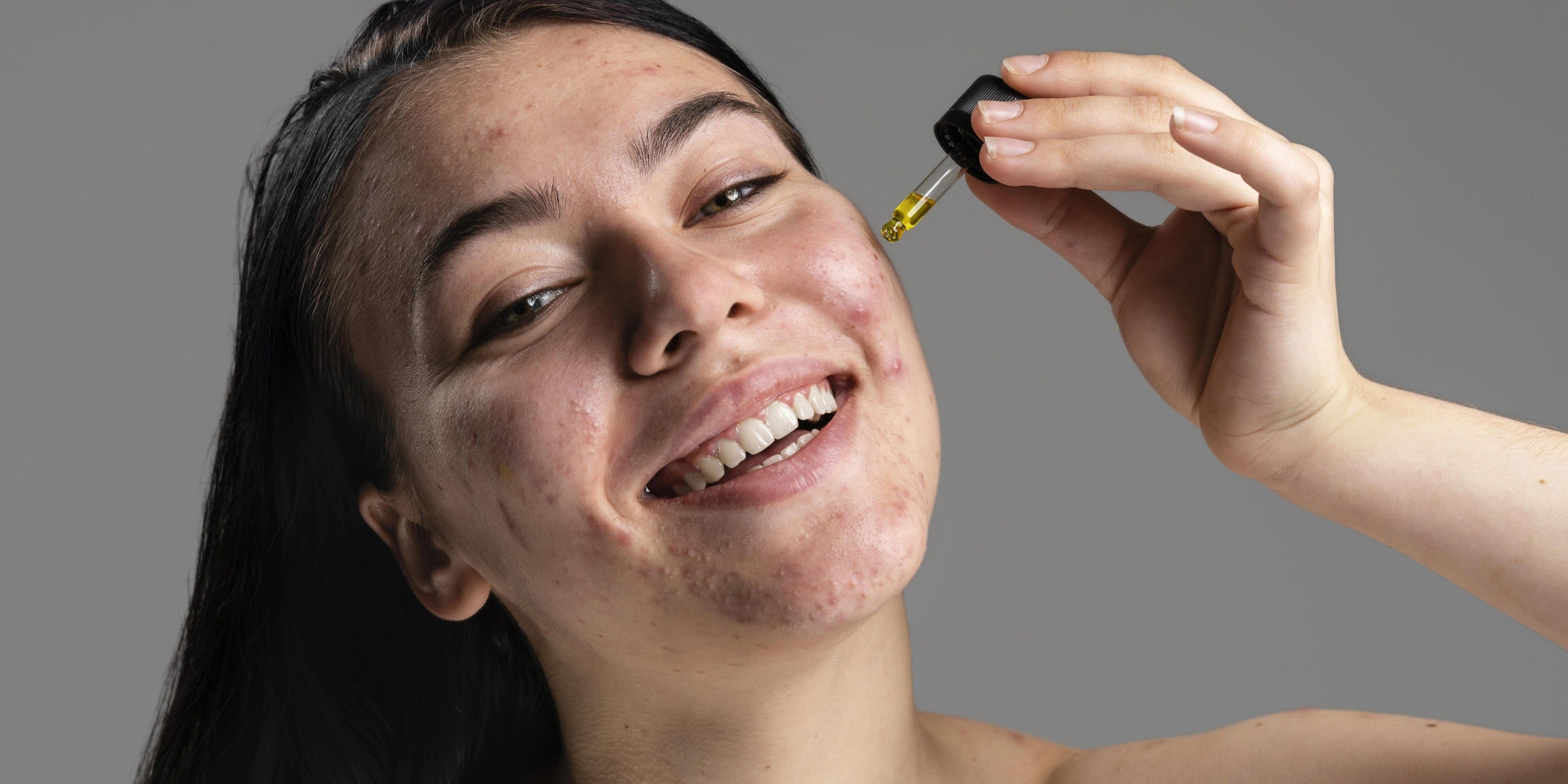 A Gentle Guide to Calming Hormonal Acne on Sensitive Skin