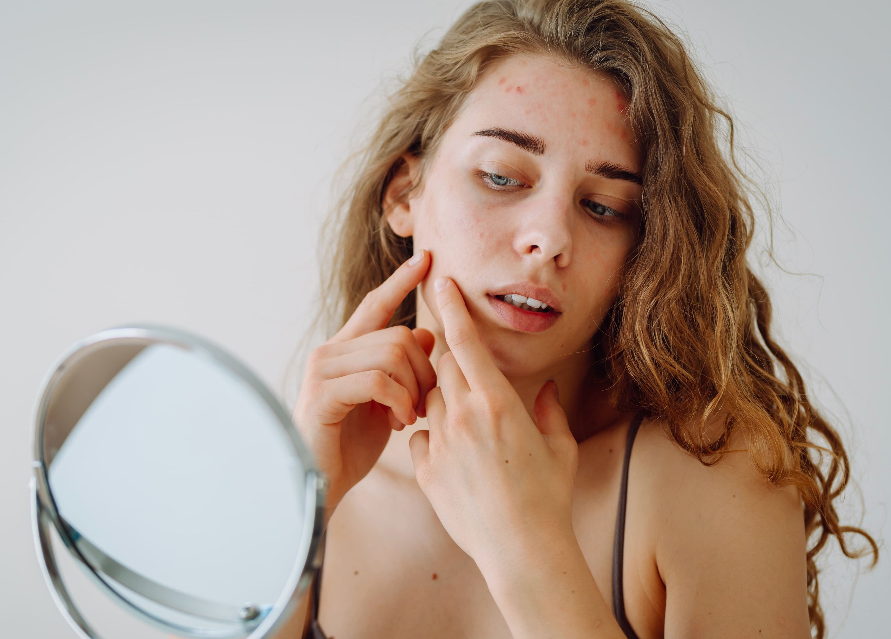 Breaking Down Stress Acne: How Cortisol Can Wreck Your Skin