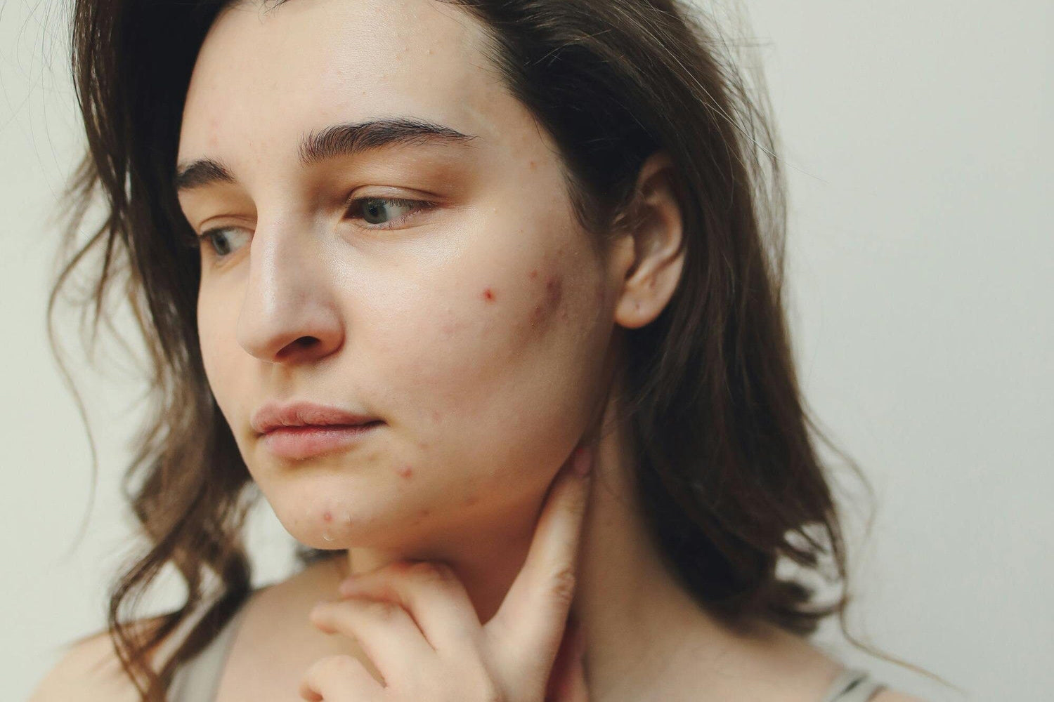 Calming Post-Acne Redness on Sensitive Skin: A Natural Skincare Guide