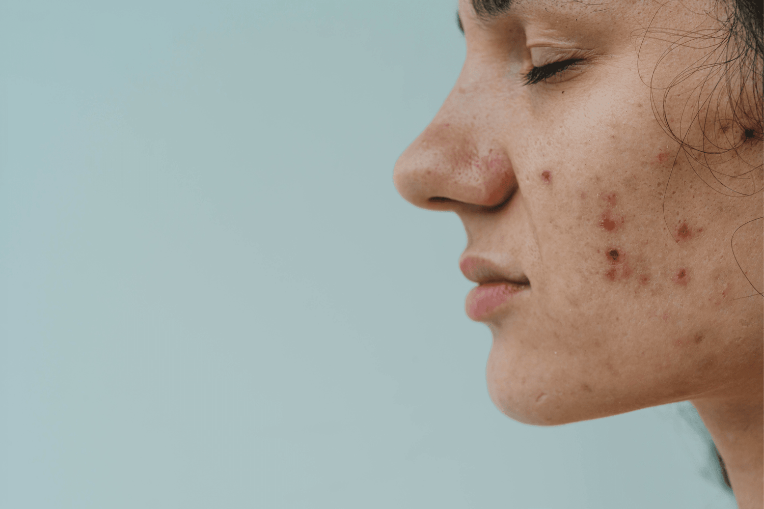 How to Treat Hormonal Acne Naturally (Without Harsh Chemicals)