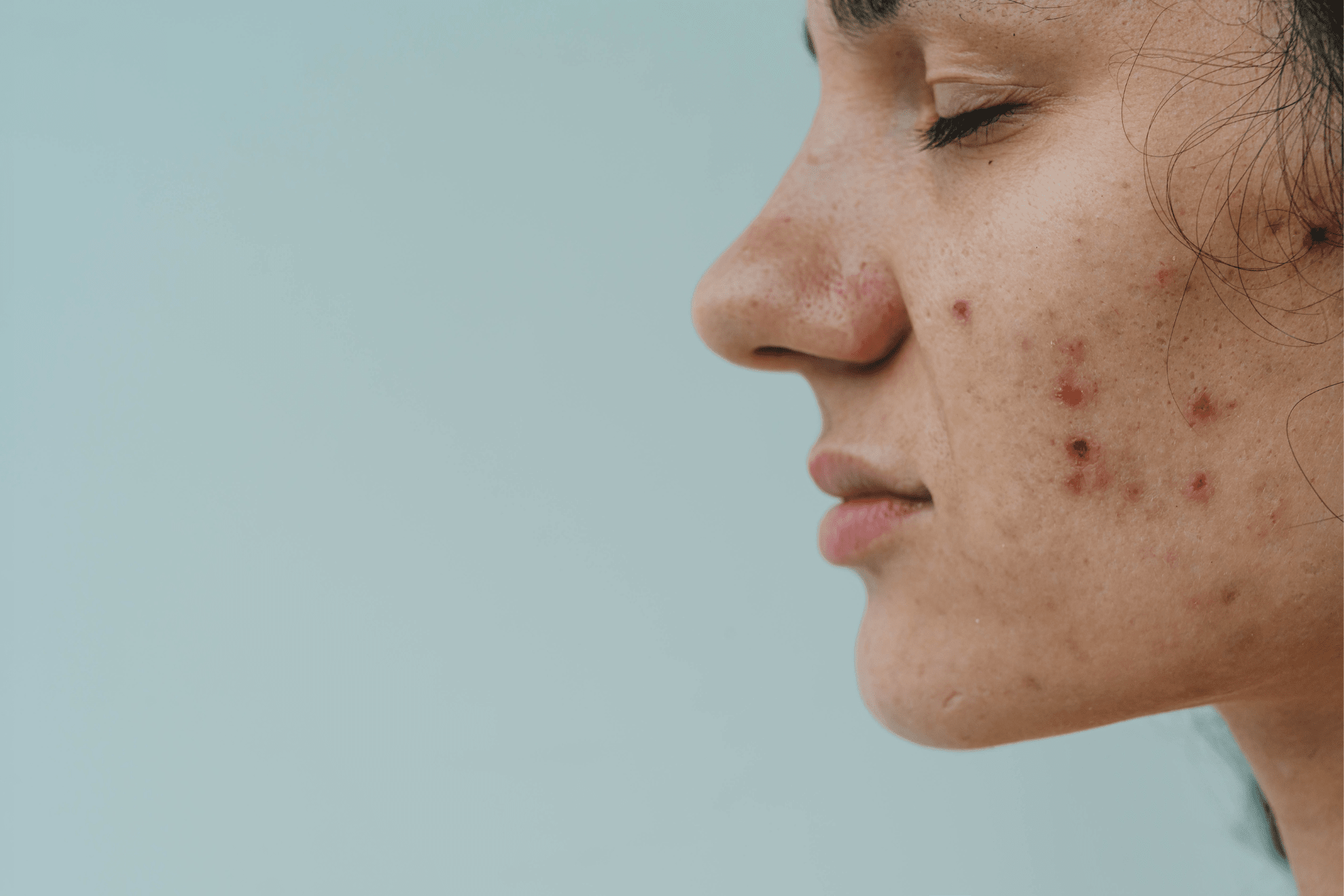How to Treat Hormonal Acne Naturally (Without Harsh Chemicals)