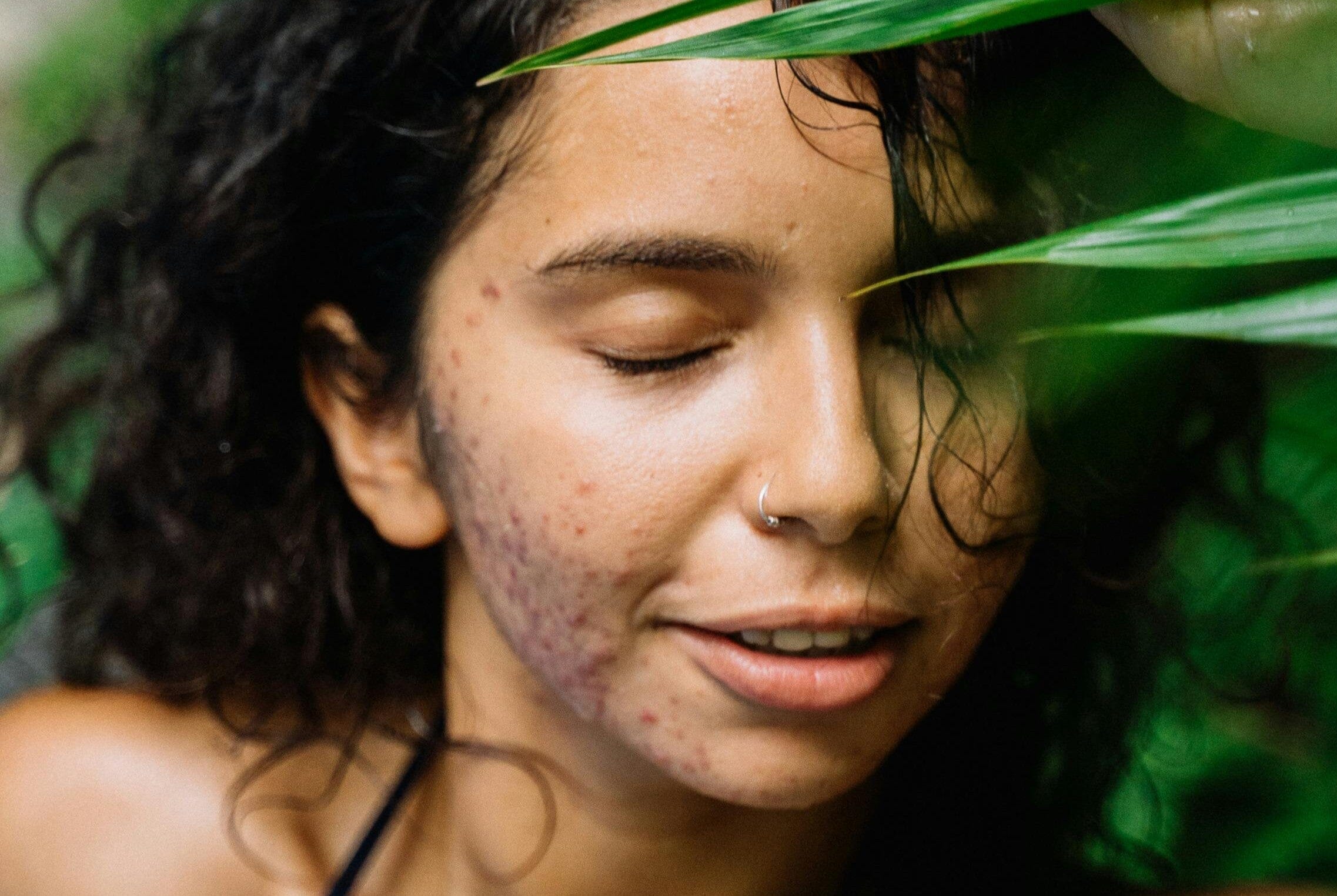 Is Blue Tansy the Secret to Calming Inflamed Acne Naturally?
