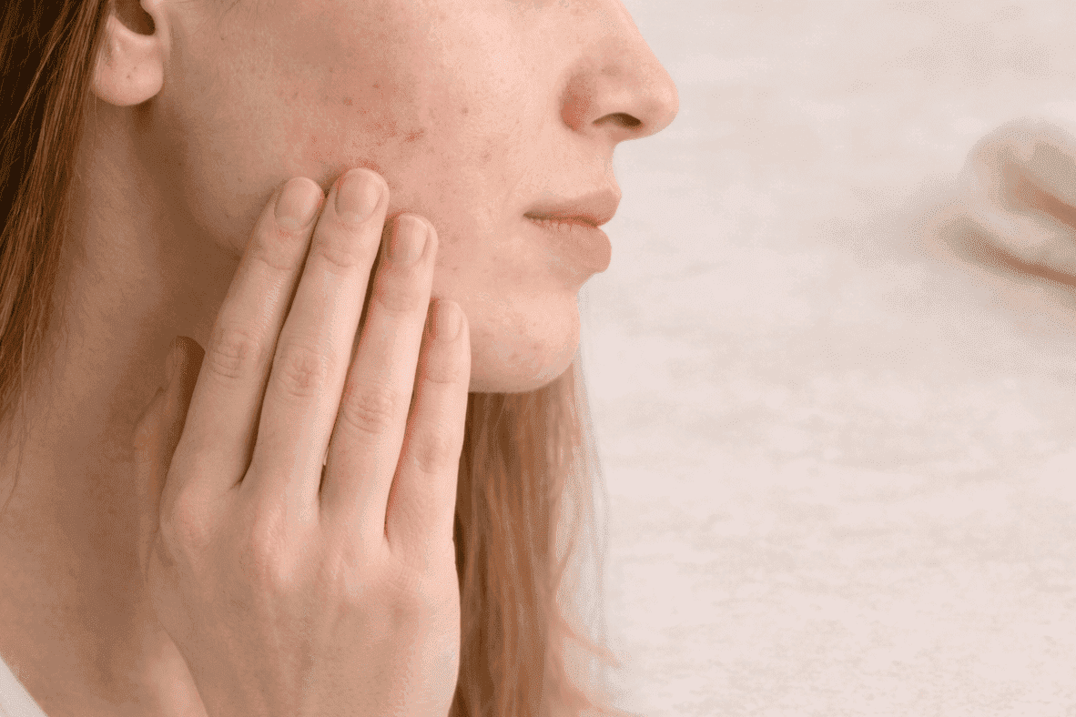 Is Your Skin Purging or Just Plain Angry? A Guide to Natural Acne Treatments for Sensitive Skin