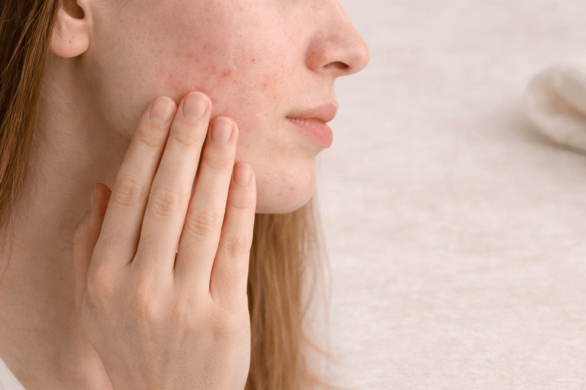 Is Your Skin Purging or Just Plain Angry? A Guide to Natural Acne Treatments for Sensitive Skin
