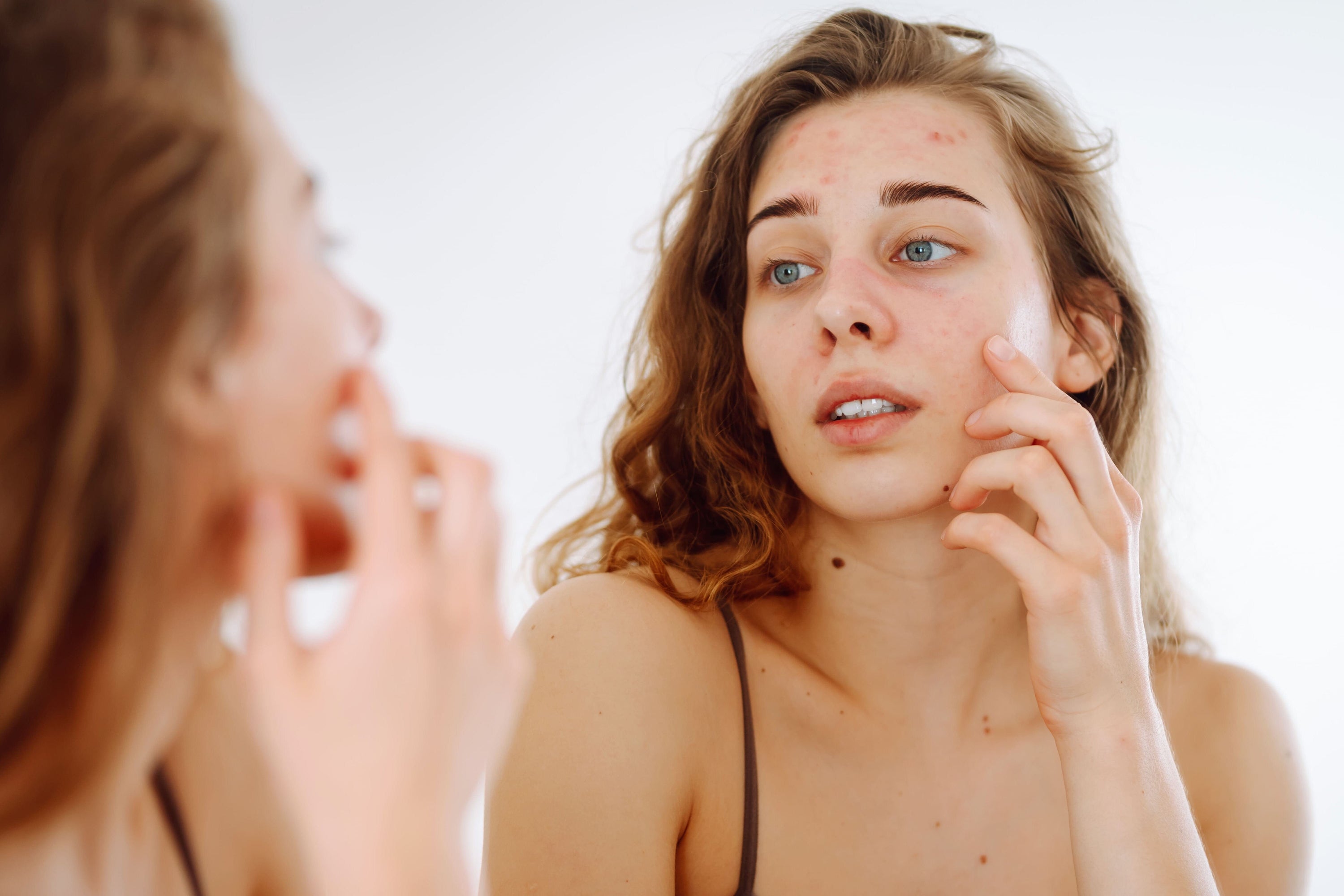 Sensitive Skin in Summer? How to Calm Rosacea Naturally