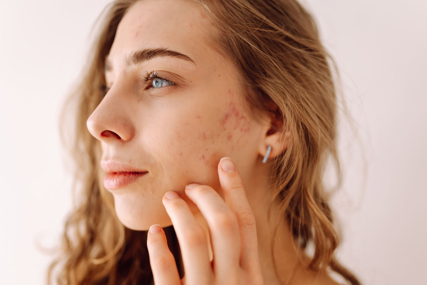 Why Stress Is Triggering Your Perioral Dermatitis? & How to Calm It Naturally